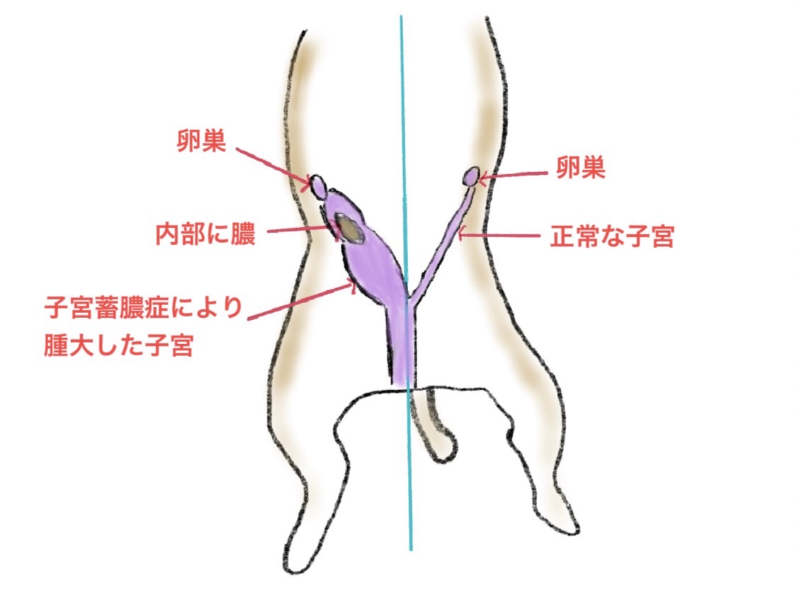 子宮蓄膿症に内科治療！？